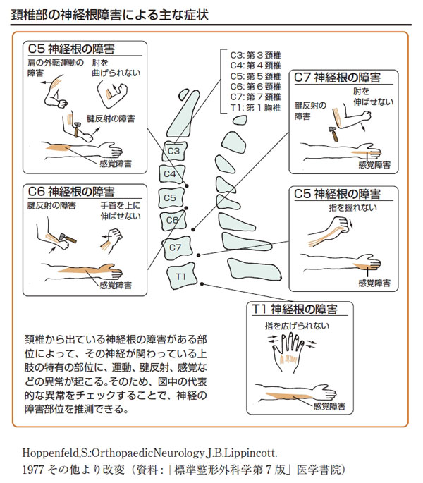 頚部脊椎症２